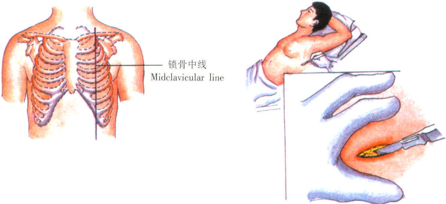 肋間徑路